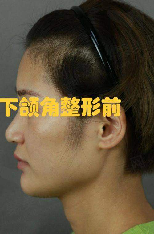 重庆松山医院夏德林医生做正颌、颧骨、下颌角磨骨手术怎么样？