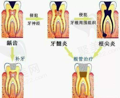 成都医大口腔医院做后牙根管治疗的具体优势