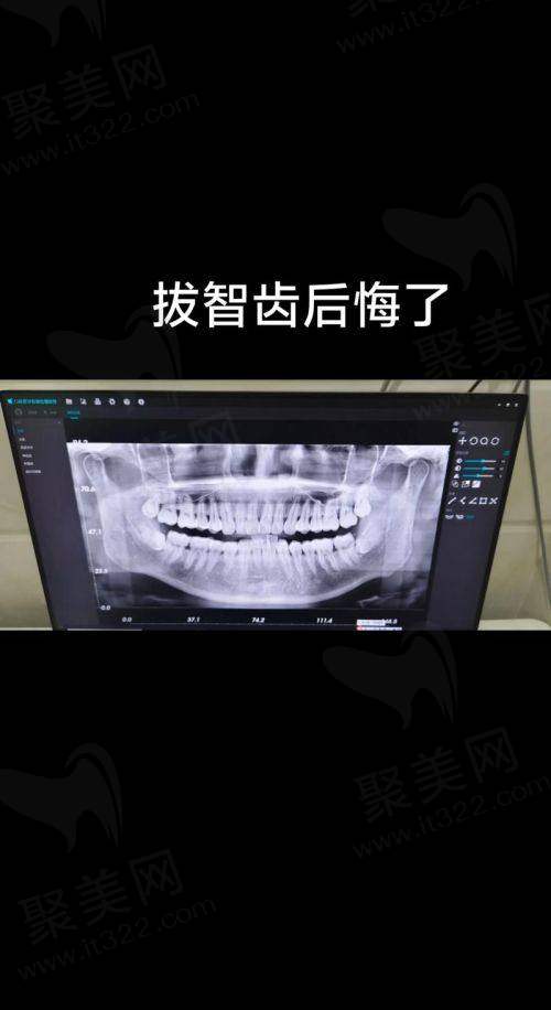 郑州植得口腔医院拔上颌正位已萌出智齿199元起，多院区服务贴心助你轻松摆脱智齿困扰