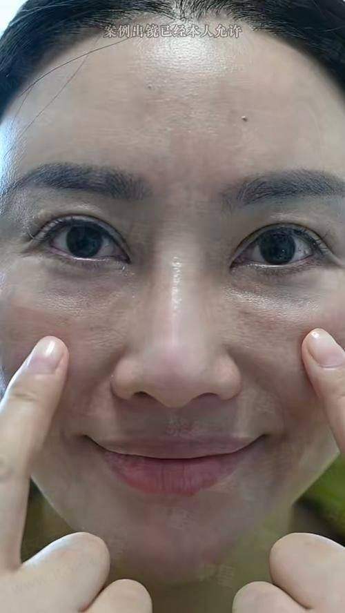 吴贞跃做手术成功率怎么样？2000+实例证明，吴贞跃取生长因子与馒化脸修复超厉害