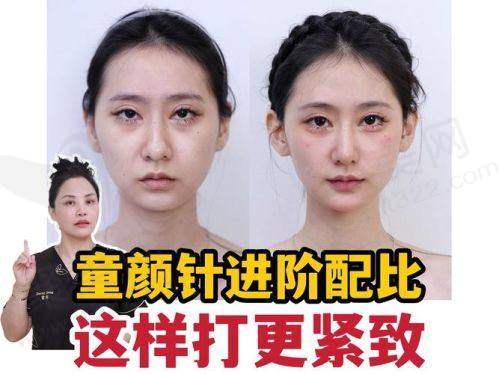 重庆艺星朱星蓉注射乔雅登极致玻尿酸7710元起，更适合用于面部塑形和深层皱纹的填充