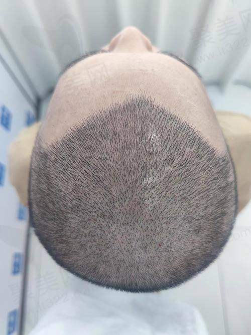 广东崇爱植发医院口碑评价