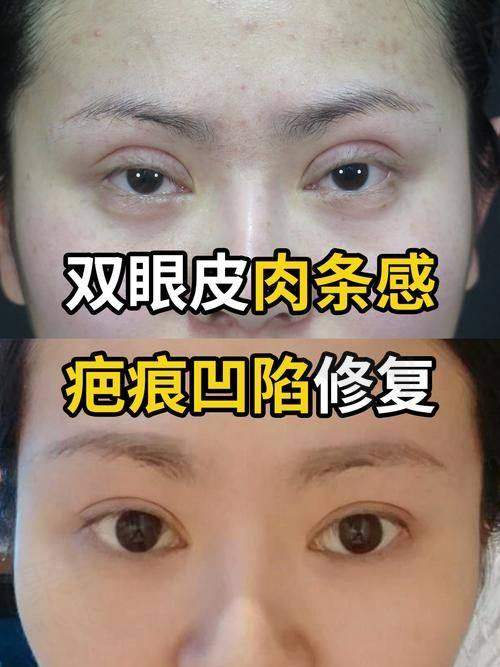 广州新市医院吕方中医生修复双眼皮口碑技术双优，18000元起享自然美眼！