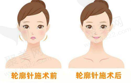 选择广州治疗富贵包医院的建议