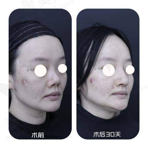 重庆艺星朱家旭全肋鼻修复68750元起——优势分析