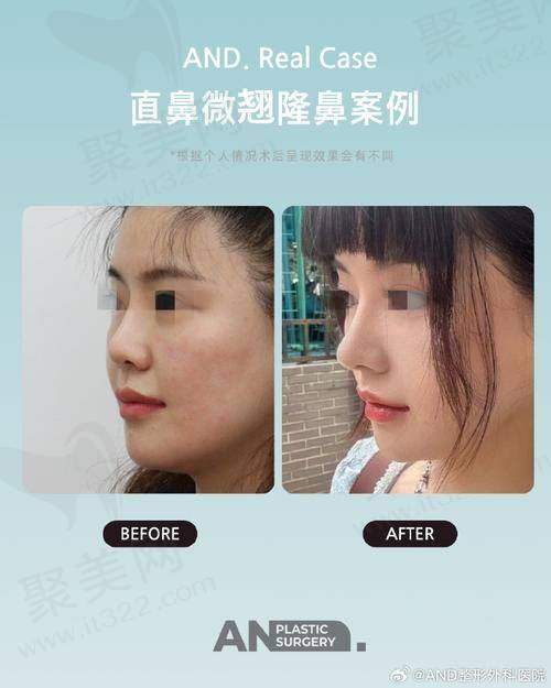 重庆艺星朱家旭隆鼻的价格分析