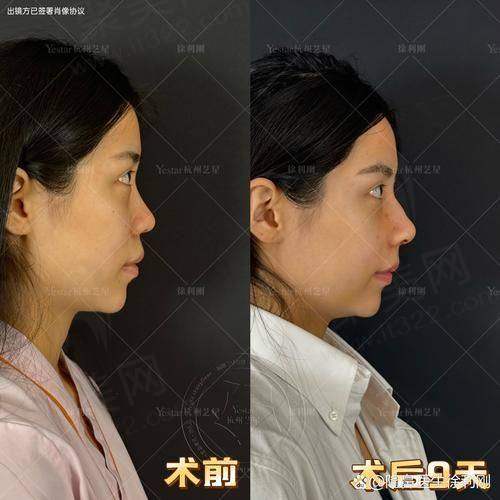 重庆艺星朱家旭全肋鼻修复68750元起——总结与推荐