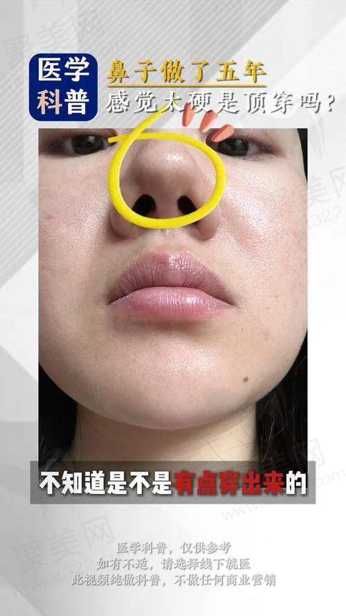 重庆艺星朱家旭全肋鼻修复68750元起——价格分析