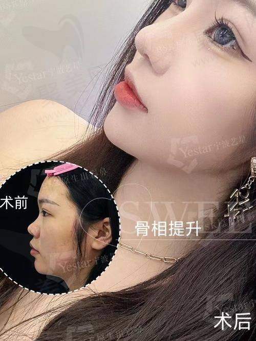 重庆艺星朱家旭隆鼻技术好评如潮全肋鼻修复68750元起，个性化定制手术方案让你轻松拥有理想鼻型
