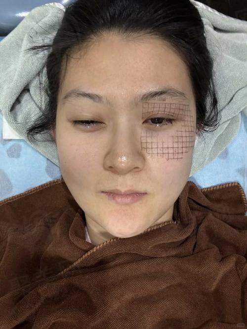 珠海热玛吉法定授权三家医院公布——珠海爱思特医疗美容医院热玛吉优势