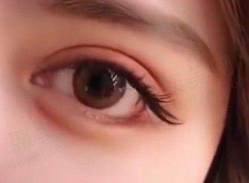 患者对深圳阳光医疗美容医院李鹏做切开双眼皮的真实口碑评价