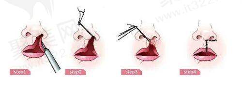 5. 其他整形项目价格