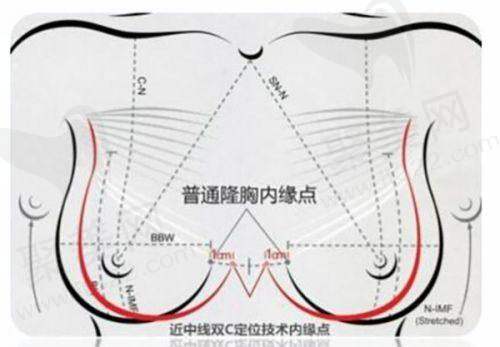 深圳美莱美容整形医院正规吗？
