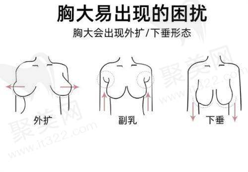 鼻整形实例分享