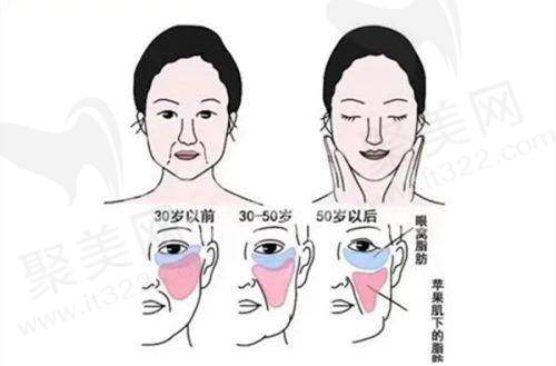 2. 眼部整形价格