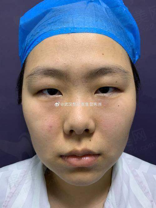 深圳阳光医疗美容医院李鹏做眼部综合6项项目价格解析