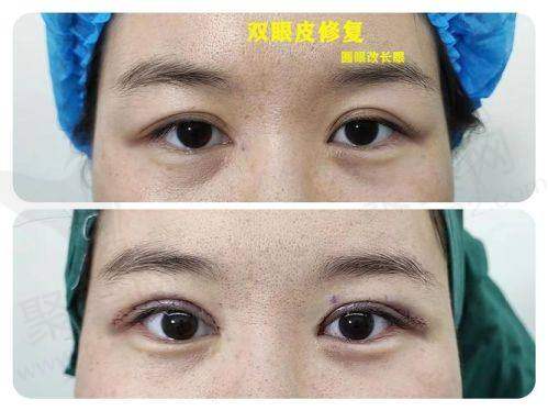 深圳阳光医疗美容医院李鹏做切开双眼皮项目价格解析
