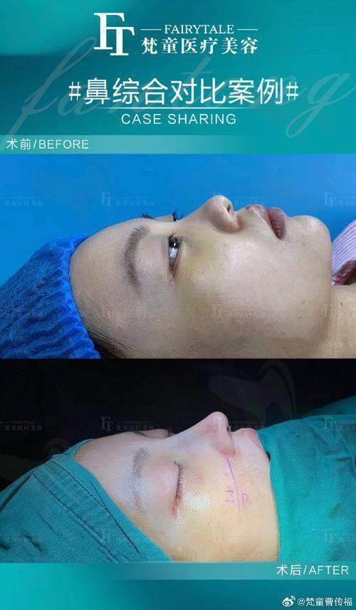 重庆艺星朱家旭超肋鼻修复手术的技术精选