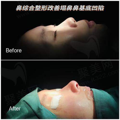 重庆艺星朱家旭超肋鼻修复手术价格39800元起，效果显著，真实案例揭秘，值得信赖的整形选择