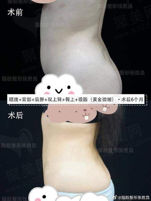 重庆艺星朱家旭腰腹水动力吸脂成效明显