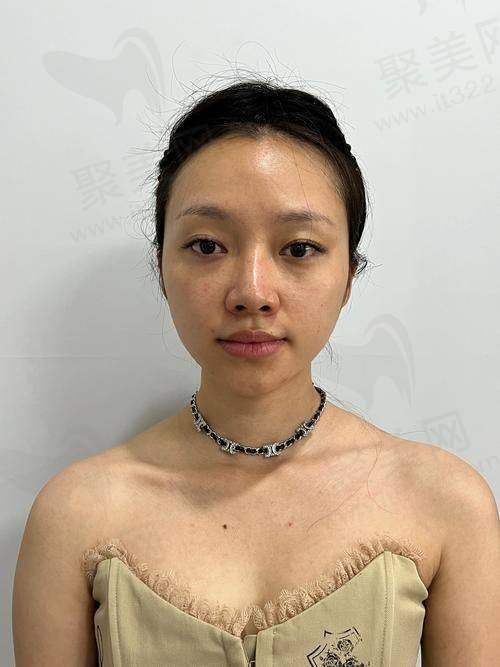 一、饮食调整降尿酸
