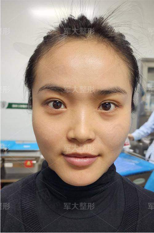 三、医疗干预控尿酸