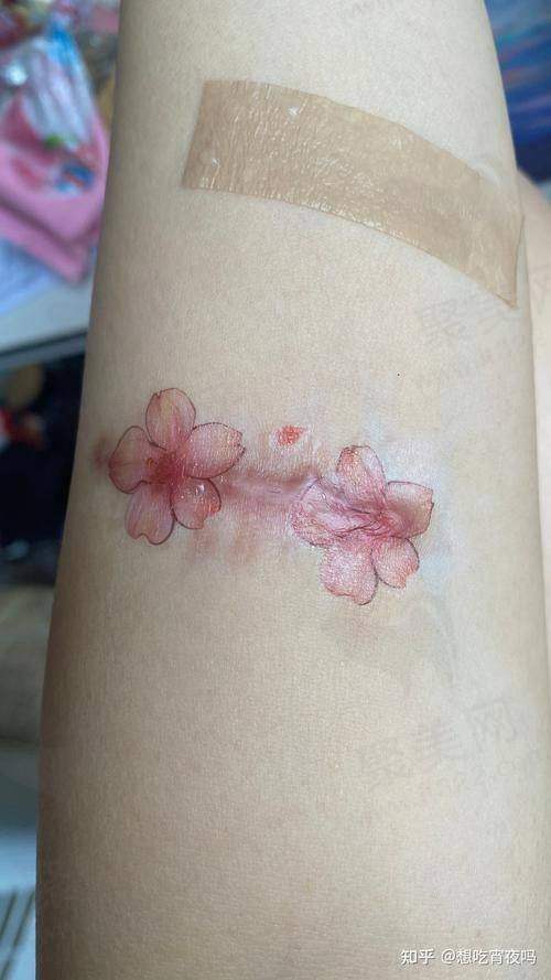 上海虹桥医院疤痕科点阵激光除痘坑的显著作用