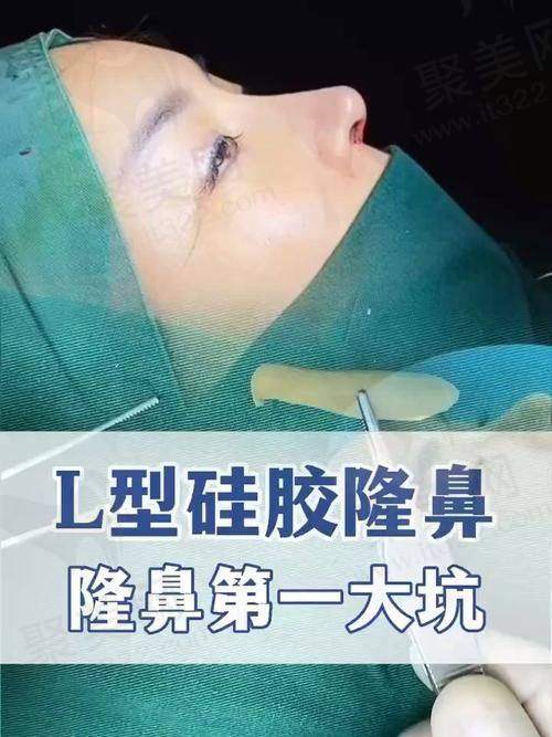 成都友谊整形硅胶假体隆鼻技术有哪些优势？