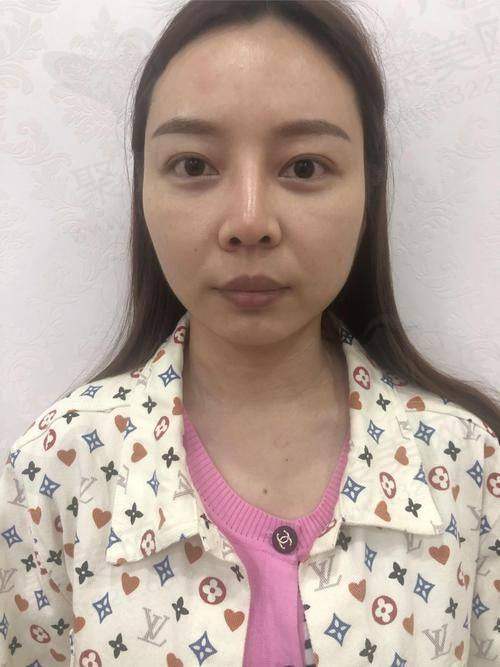 成都友谊整形张立天医生硅胶假体隆鼻的水平如何？