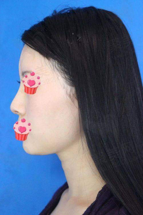 成都友谊整形硅胶假体隆鼻有哪些成功实例？