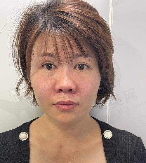 成都友谊整形鼻基底成形术8800元起，李从从医生定制个性化变美方案