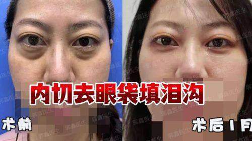 患者对深圳阳光医疗美容医院李鹏做内切去眼袋的真实口碑评价