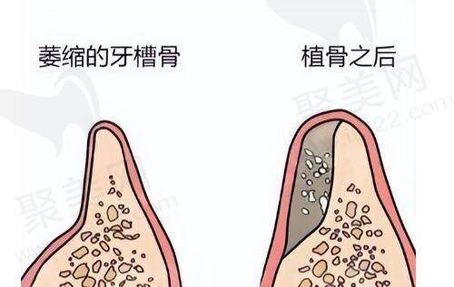 深圳福雅胡俊杰医生做人中缩短成效如何？