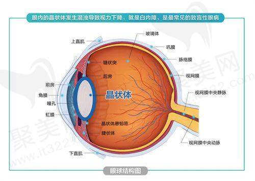 申请免费白内障手术需符合的三个条件