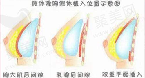深圳福雅胡俊杰医生做假体丰臀表现如何？