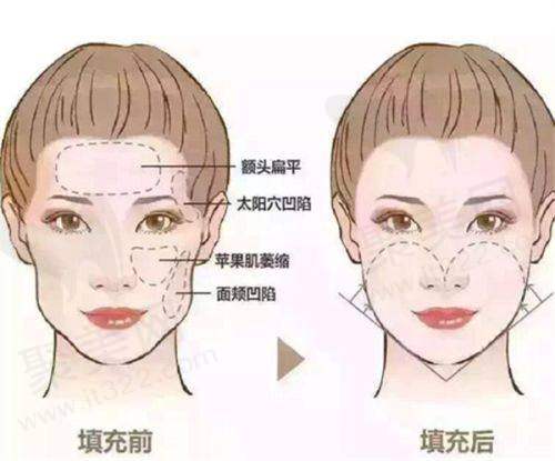 郑州芊美王浩医生隆鼻整形怎么样？
