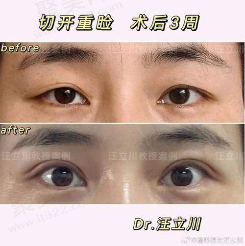 北京丰联丽格师丽丽眼整形价格是怎样的？