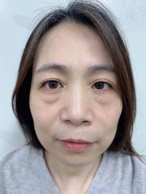 北京晶美医疗美容 - 激光仪器溶脂祛眼袋