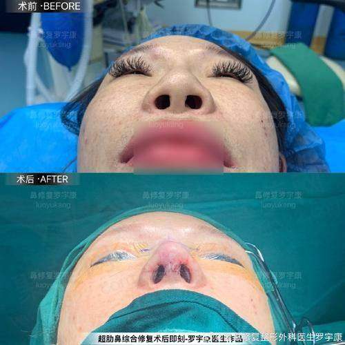 重庆艺星朱家旭耳软骨隆鼻技术详解，了解价格与效果，耳软骨鼻综合9750元起，助你找回自信美丽