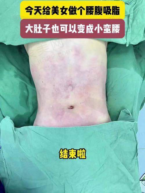 肚子吸脂视频全过程揭秘：15天恢复效果显著，水动力吸脂让你轻松瘦身！