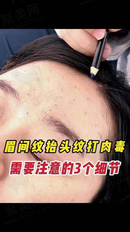 二、有效去除法令纹的医美办法