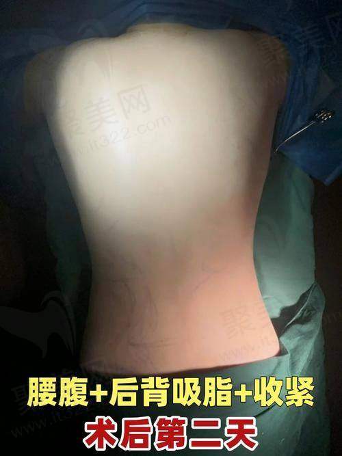 二、王仁根医生吸脂技术优势