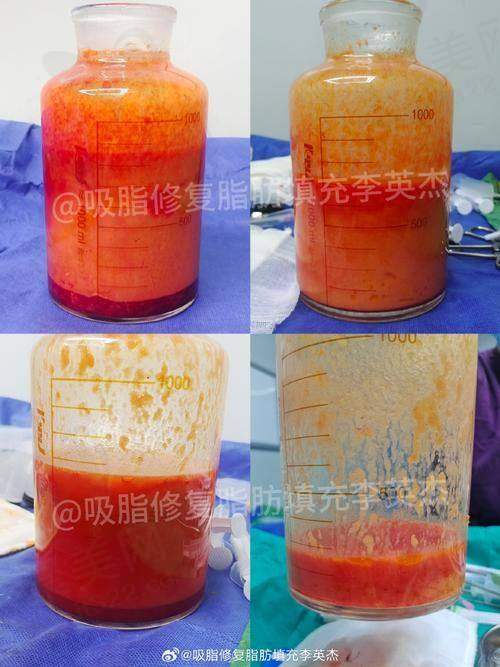 三、彭才学与徐怀河医生技术对比