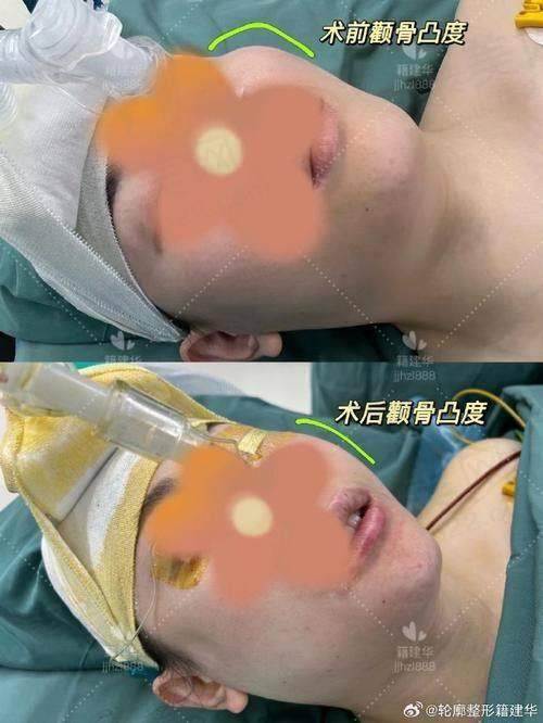 重庆艺星朱家旭硅胶假体垫下巴的价格分析