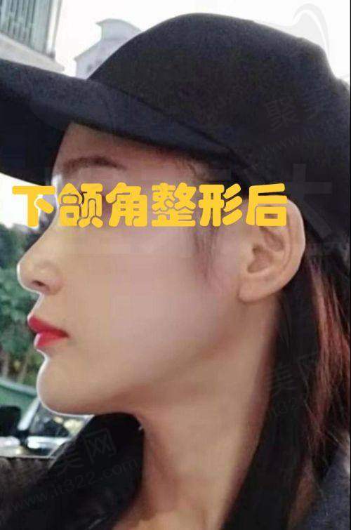 重庆艺星朱家旭硅胶假体垫下巴的技术优势