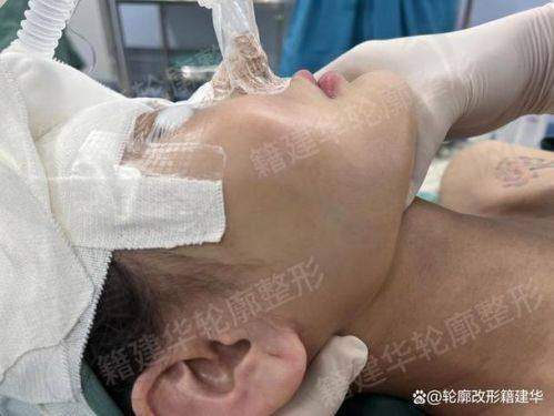 总结重庆艺星朱家旭硅胶假体垫下巴6750元起的优势