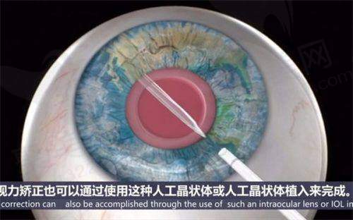 五、保定鹰华眼科医院怎么预约：