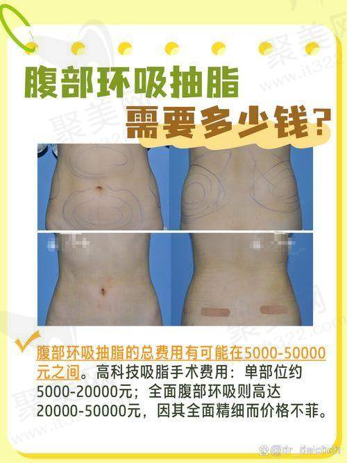 吸脂肚子10斤多少费用？肚子吸脂费用揭秘：抽脂10斤价格22k-35k，选择正规机构确保安全与效果