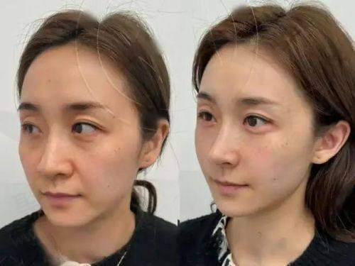 五、注射玻尿酸的危害和后遗症