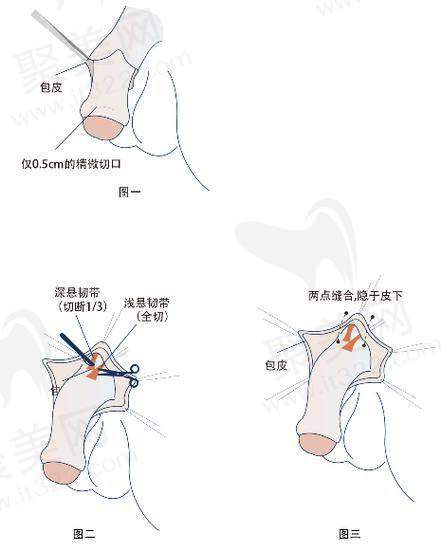 男科增粗：生物补片能增粗多少？安心美观有保护